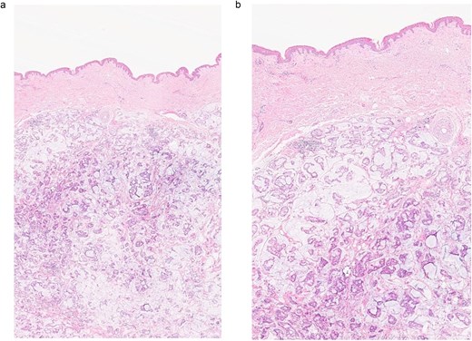 (a, b) Section of skin showing dermal lesion composed of nests of tumor cells floating in pools of extracellular mucin.