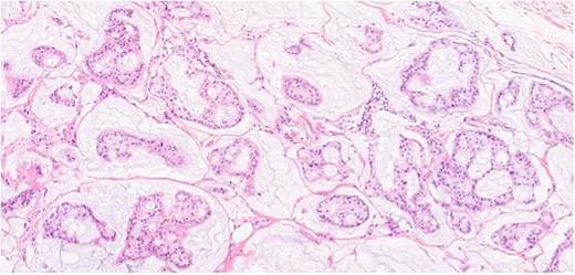 Section showing tumor cells with low to intermediate nuclear grade floating in pools of extracellular mucin separated by fibrous septa.