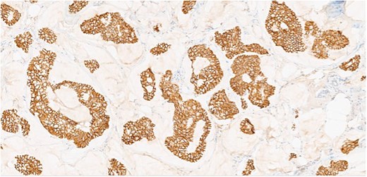 Section of tumor showing HER2 expression in the tumor cells.