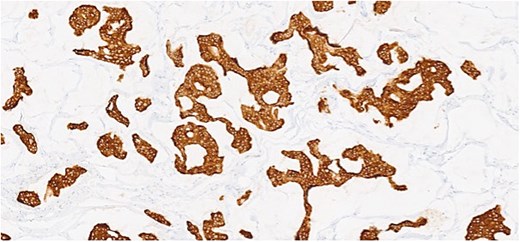 Section of tumor showing strong positivity for CK7.