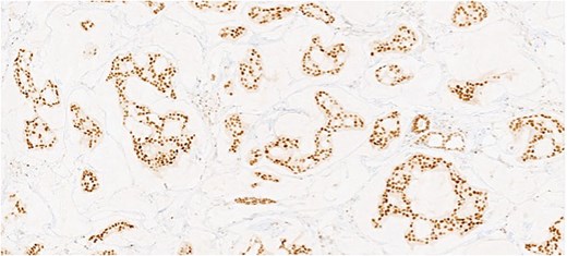 Section of tumor showing strong nuclear positivity.