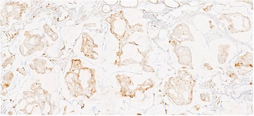 Tumor cells with focally positivity for p16.