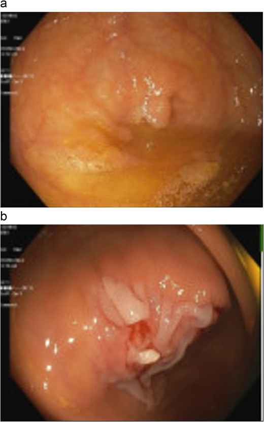 Appendiceal orifice with polyp (a); post-polypectomy incomplete resection (b).