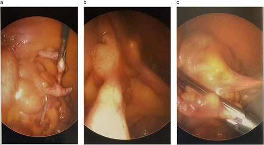 Intraoperative view of appendectomy with cecal cuff.