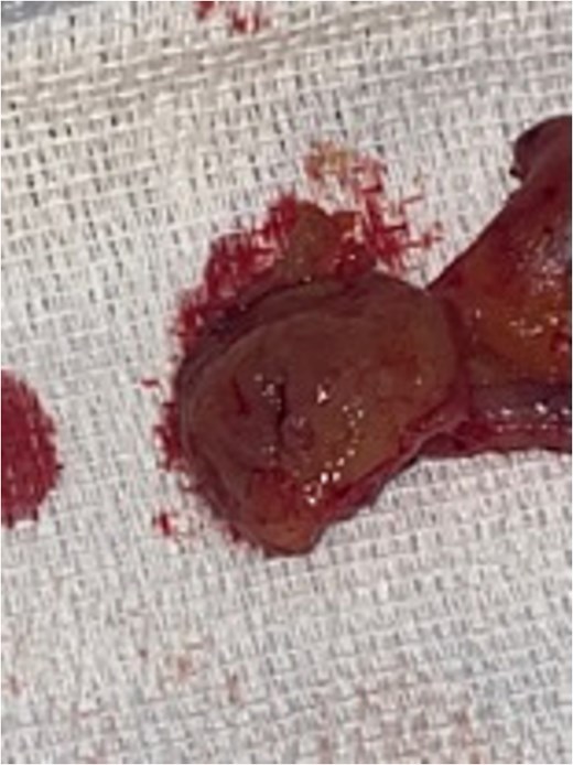 Resected appendix with cecal cuff and polyp.
