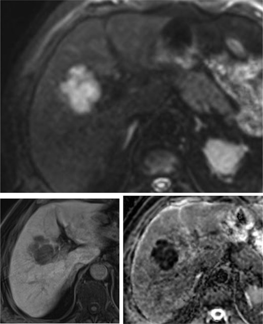 MRI of the liver with single poly-lobulated, smoothly delineated mass in the right liver lobe.
