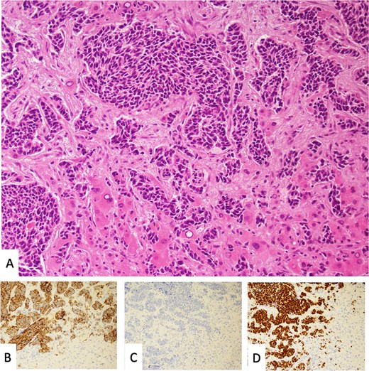 Liver metastasis of a small cell carcinoma. (A) Small to intermediate-sized tumor cells with dense chromatin, scant cytoplasm and brisk mitotic activity. Adjacent pre-existing liver tissue. (B) Expression of chromogranin/synaptophysin. (C) Negative for p40. (D) Positive staining for TTF1.
