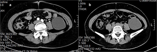 (a) Retroperitoneal enhanced CT shows a lobulated homogeneous cyst in the left lower abdomen. (b) A year later, there was no change in the size, shape, or characteristics of the cyst.