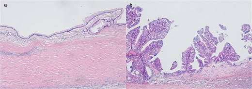 (a) Mucinous cystadenoma with a single layer of columnar epithelium with abundant intracellular mucin (HE, 4×). (b) PBMCTB shows papillary growth of stratified mucinous epithelium with nuclear atypia (HE, 4×).