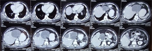 CECT abdomen pelvis showing bilobar hepatic hydatid cyst.