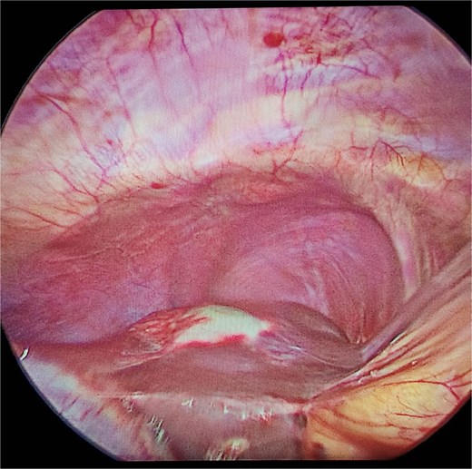 Laparoscopic view of hepatic hydatid lesion (white focus on the liver surface).