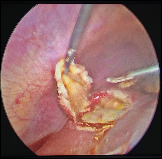 Laparoscopic pericystectomy for hepatic hydatid cyst.