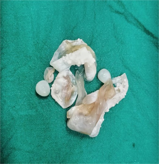 Excised hydatid cysts.