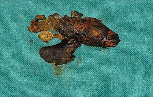 Intraoperative view of the giant common bile duct (CBD) stone measuring 6 × 4 × 4 cm, extending into the cystic duct and common hepatic duct.