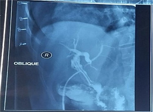 Postoperative T-tube cholangiogram confirming complete stone clearance with no residual filling defects in the CBD.