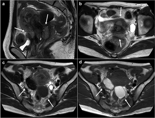 Magnetic resonance images. (a) Sagittal T2 weighted image. (b) Axial T2 weighted image. (c) Axial T1 weighed image. (d) Axial T2 weighed image. Tumors are observed at either the anterior or posterior portion of the urine cervix (a, b: arrows). Ovarian endometriosis is observed in both ovaries (c, d: arrows). Walls of the cysts are smooth.