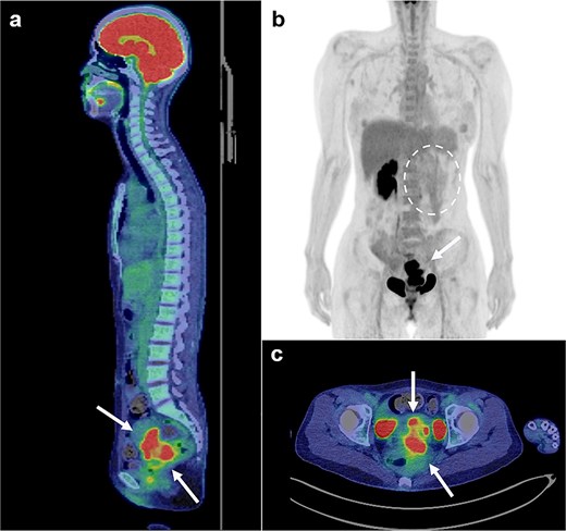 FDG positron emission tomography and computed tomography scans (FDG PET/CT). FDG PET/CT revealed that the mass that had FDG uptake solely in the pelvis (a, b, c: arrows). The left kidney did not uptake FDG because it was non-functioning (b: circle with dotted line).