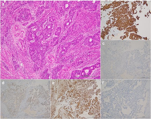 Histopathological findings. Hematoxylin–eosin staining (a) revealed that the histological type was endometrioid carcinoma, grade 3, immunohistochemical staining (b–f) showed positive results for CD7 (b), PAX-8 (d), and ER (e) and negative results for CD20 (c) and CDX-2 (f).