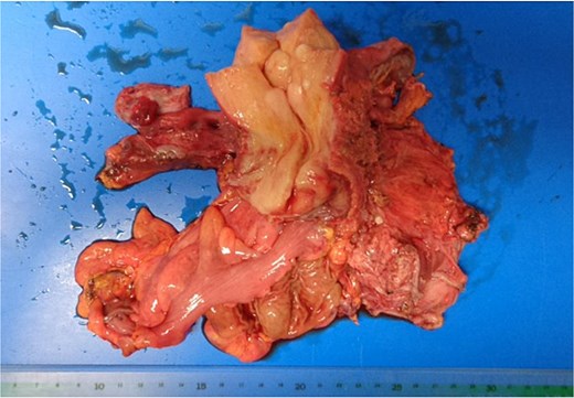 Surgical specimen. The rectum and left ureter were resected together with the uterus.