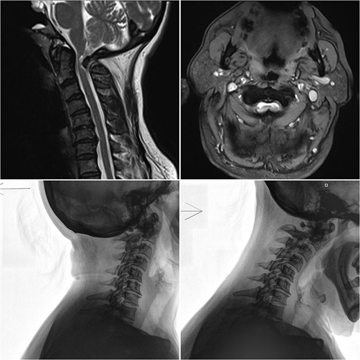Sagittal and axial MRI, along with flexion/extension X-rays of the cervical spine, demonstrating anterior C1 subluxation, central canal narrowing, and myelopathy.