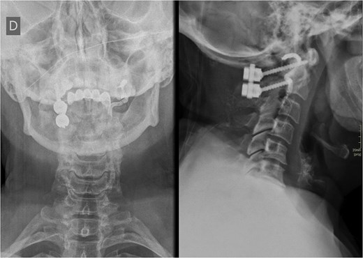 Postoperative X-ray of the cervical spine showing contralateral unilateral C1-C2 fixation and the left VA opacified with a radiopaque contrast agent.