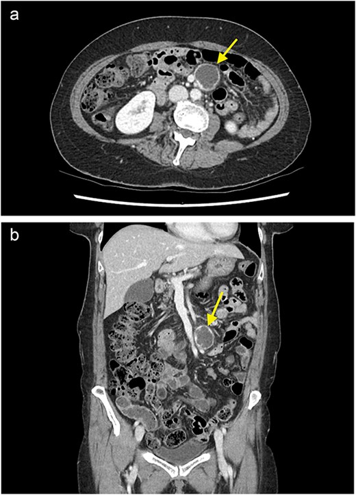 A contrast enhanced CT of the abdomen and pelvis (portal venous phase) with axial (a) and coronal (b) views demonstrating a cystic lesion in the small bowel mesentery (arrow).