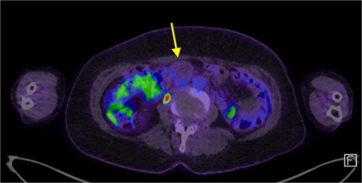 A FDG PET scan in axial view demonstrating a minimally FDG avid lesion in the small bowel mesentery (arrow).