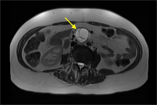 An MRI (T2 HASTE) in axial view demonstrating well-defined T2 hyperintense cystic mass (arrow).