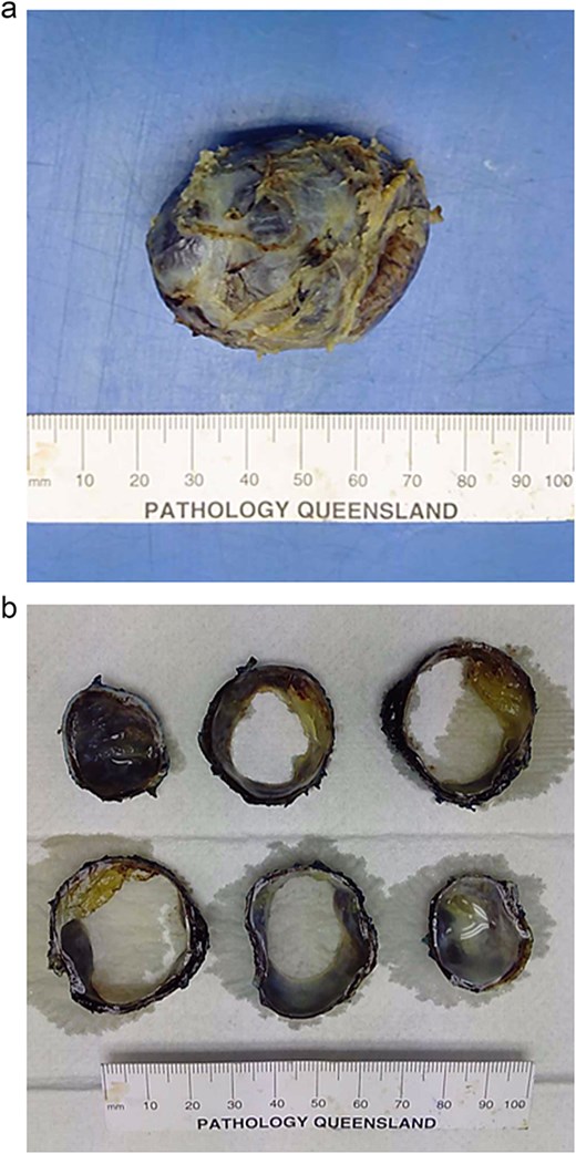 Macroscopic photographs of the unilocular cystic lesion whole (a) and sliced (b).