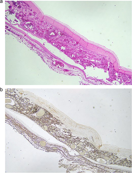 (a) 2× magnification, routine haematoxylin and eosin sections show a proliferation of variable sized vascular spaces lined by cytologically bland endothelial cells with a central pseudocyst. The pseudocyst has an incomplete hypocellular fibrous wall with no true lining and is filled with degenerate blood. These findings are in keeping with a haemangioma with evidence of a previous haemorrhage forming a central pseudocyst. (b) 2× magnification, CD34 immunohistochemical stain highlights the vascular channels.
