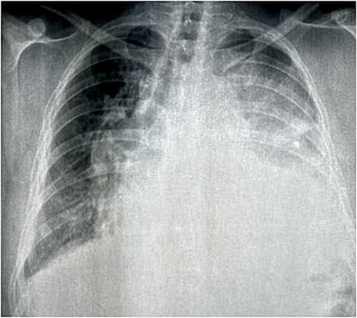 Chest X-ray showed a left opacity that encompassed the cardiac outline and displaced the trachea and stem bronchi on the right.