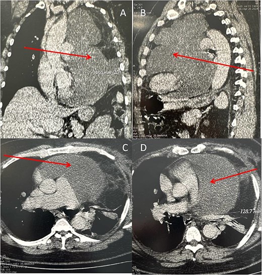 Chest CT scan (A: coronal section, B: sagittal section, C and D: axial section) in spiral mode with injection of contrast agent showing a giant pericardial mass (arrows).