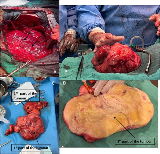 (A) Intraoperative image showing the tumour (arrow). (B) First part of the tumour removed, compared macroscopically with a hand. (C) Complete tumour removed in two separate parts. (D) First part of the tumour dissected to reveal internal contents.
