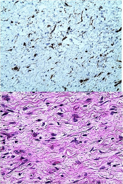 Images showing histological and immunohistochemical sections of the removed tumour.