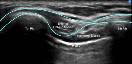 A typical ultrasound image obtained while administering the EOI block. The external oblique muscle, intercostal muscles, sixth rib, seventh rib, and pleura is labelled. The border external oblique muscle border is outlined.