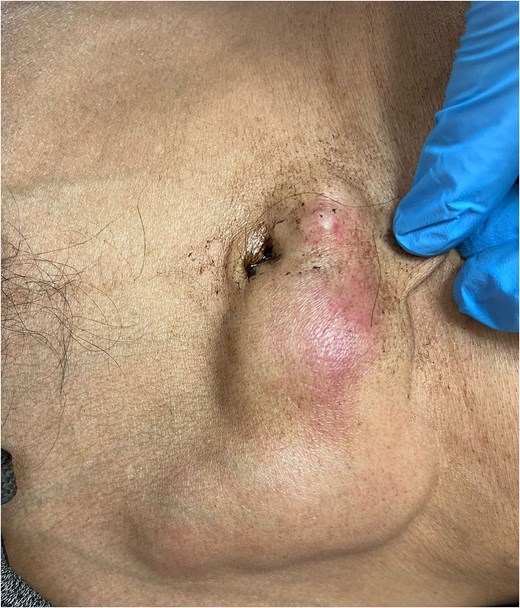 Abdominal examination revealing a non-fluctuant, irregular mass (6 × 7 cm) around the umbilicus, with minimal tenderness and erythema.