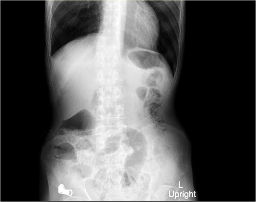 X-ray abdomen (erect) showing non-specific bowel gas distribution; no free air or masses identified.