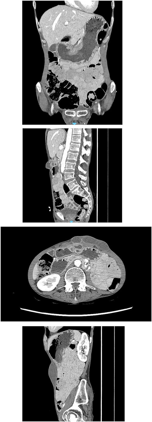 CT abdomen showing a multiloculated fluid collection at the superior greater omentum (7 × 3 × 4.6 cm) inseparable from the gastric antrum, extending into the anterior abdominal wall with a subcutaneous collection (9 × 3.5 × 2.8 cm). No free air or fluid.