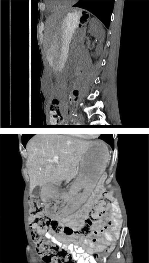 Repeated CT abdomen with oral contrast revealing no oral contrast leak into the upper anterior abdominal fluid collection.