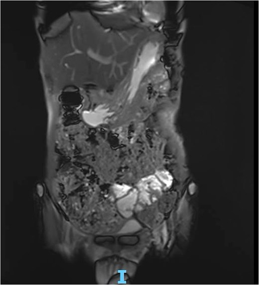 MRE showing gastric wall defect (~0.6 cm) communicating with the collection, consistent with a contained perforation. No evidence of inflammatory bowel disease.