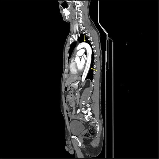 CT-scan pre-operatively showing Type A aortic dissection from the ascending aorta to the femoral arteries.