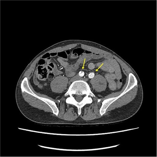 CT-scan pre-operatively showing Type A aortic dissection from the ascending aorta to the femoral arteries.