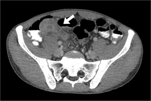 Axial view of abdominal and pelvic CT scan with oral and IV contrast shows enlarged appendix, measured 2.7 in diameter. Surrounded by fat-stranding, free fluid, with enlarged reactive lymph nodes (arrow).