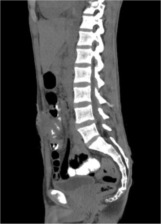 Sagittal view of abdominal and pelvic CT scan with IV and oral contrast shows anterior abdominal wall collection near the supra-umbilical wound with faint linear contrast within the collection representing enterocutaneous fistula.