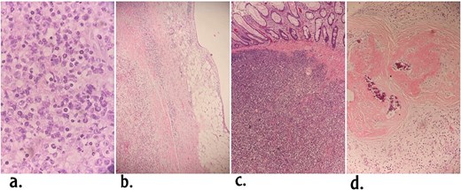 Histological features of the tumor. (a) The mucosa is diffusely infiltrated with medium sized lymphoid cells with round nuclei in the area of ileocecal valve (Hematoxylin and eosin ×40). (b) DLBCL in the appendiceal wall. (c) DLBCL in the ileocecal valve area underneath intact mucosa. (d) Calcified Schistosoma eggs in the appendix.