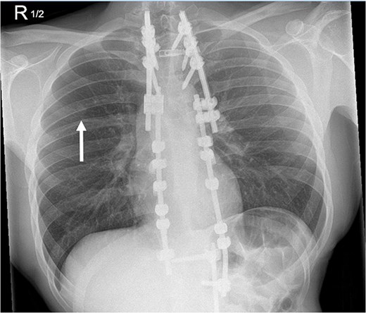 A monitoring radiograph 46 months after initial surgery noted a new nine-millimetre nodule in the right upper lung.