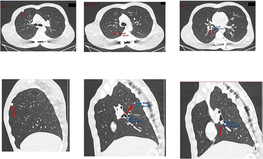 Transverse and saggital views of the three nodules identified on an investigative CT scan.
