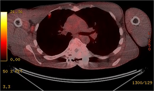 The pleural-based anterior right lobe lesion showed fluorodeoxyglucose uptake on a PET scan.