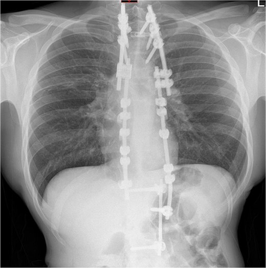 Repeat chest radiograph on re-admission to hospital with fevers and tachycardia.