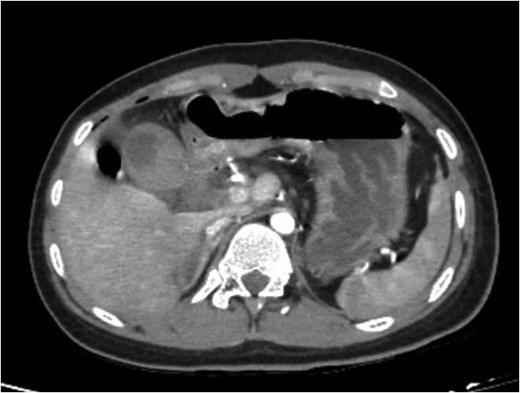 CT showing thick-walled gallbladder with some pericholecystic fluid, free abdominal air bubbles.